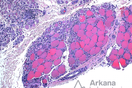 Perifascicular Atrophy, neuro notes, Arkana Laboratories, muscle biopsy