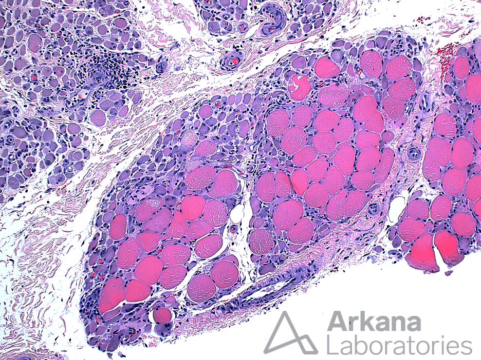 Perifascicular Atrophy, neuro notes, Arkana Laboratories, muscle biopsy
