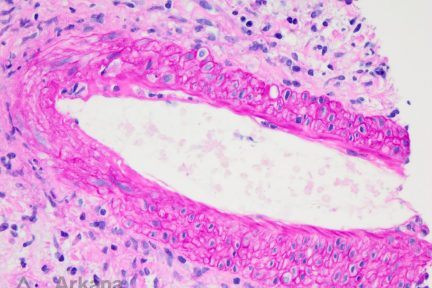 Endothelialitis, arkana laboratories, diagnose this, renal pathology, kidney pathology