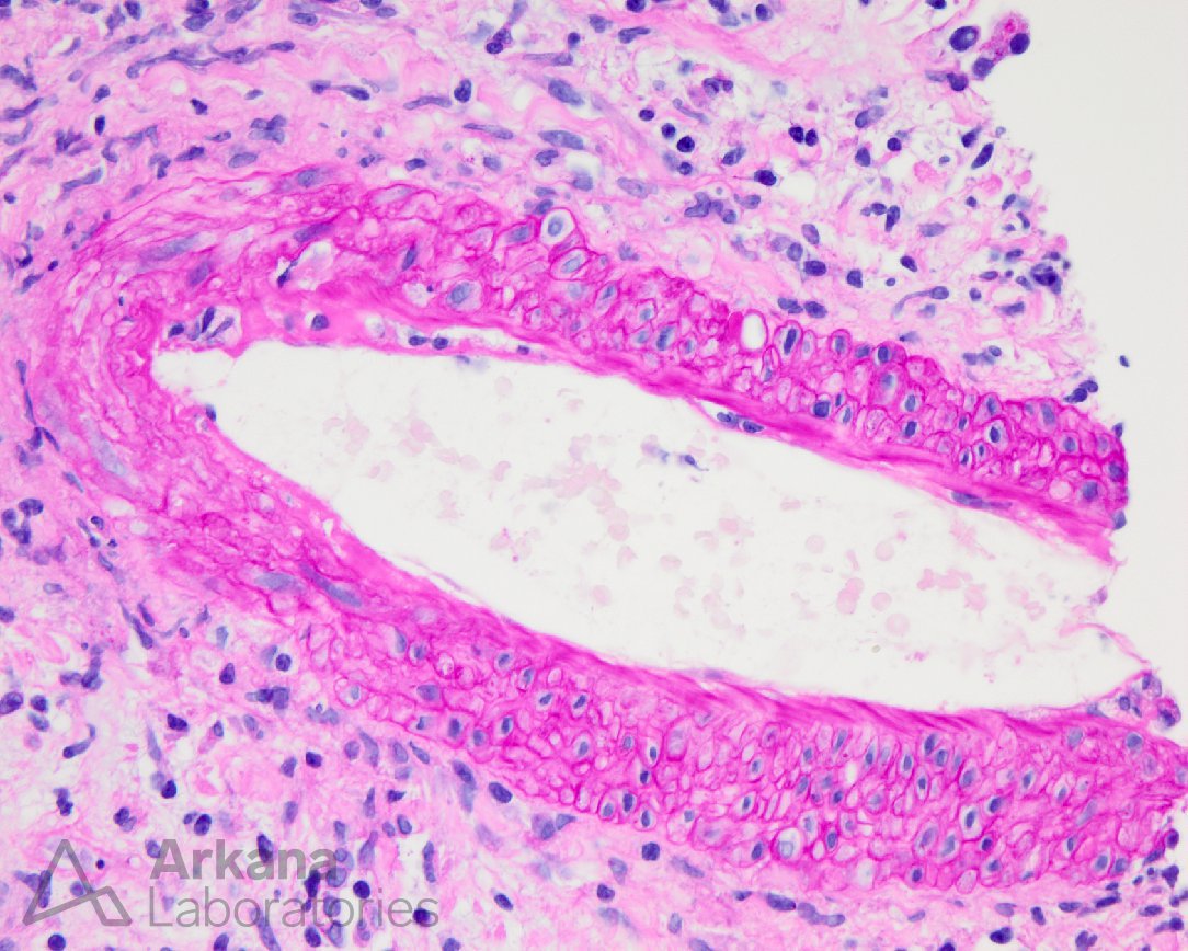 Endothelialitis, arkana laboratories, diagnose this, renal pathology, kidney pathology