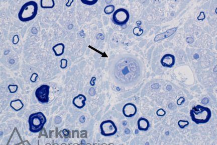 Diabetic Polyneuropathy, Hyaline thickening, neuro notes, arkana laboratories, muscle biopsy