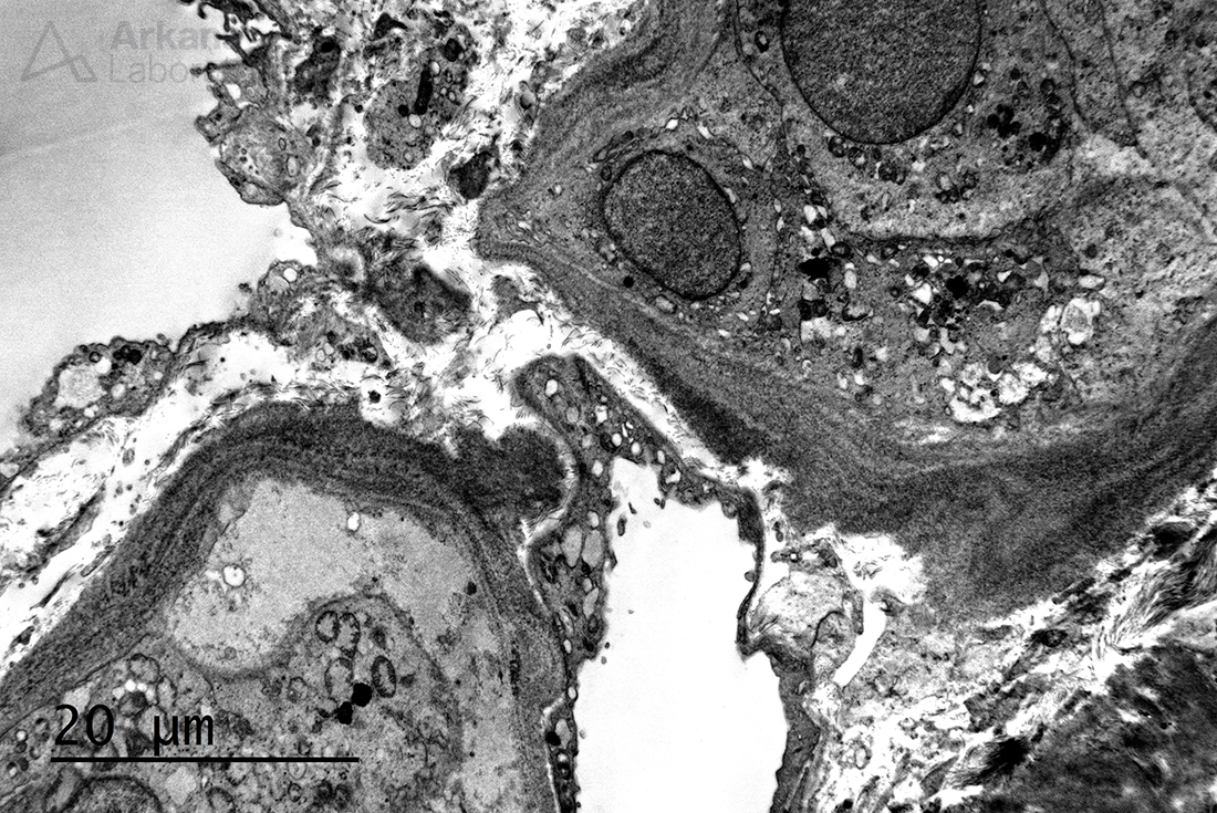 light chain deposition disease