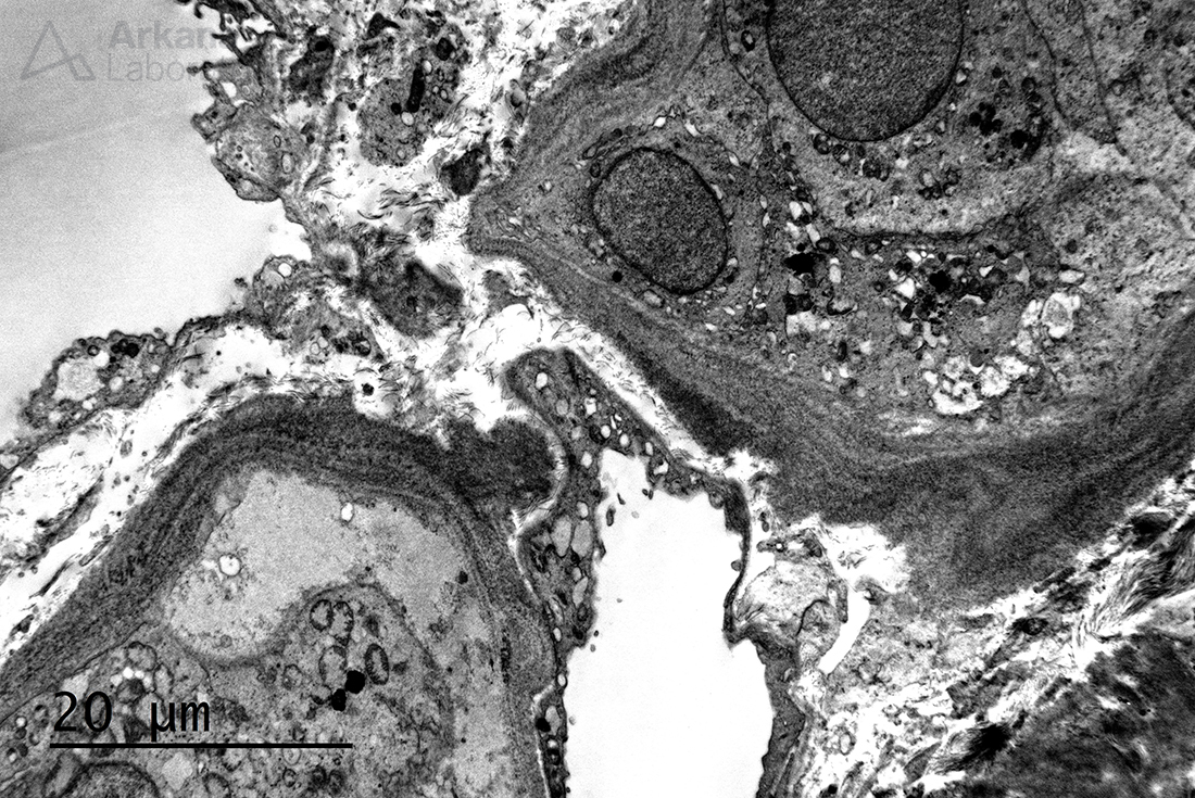 light chain deposition disease