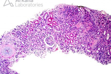 Thrombotic Microangiopathy