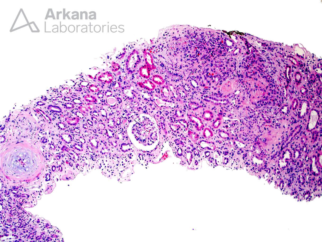 Thrombotic Microangiopathy