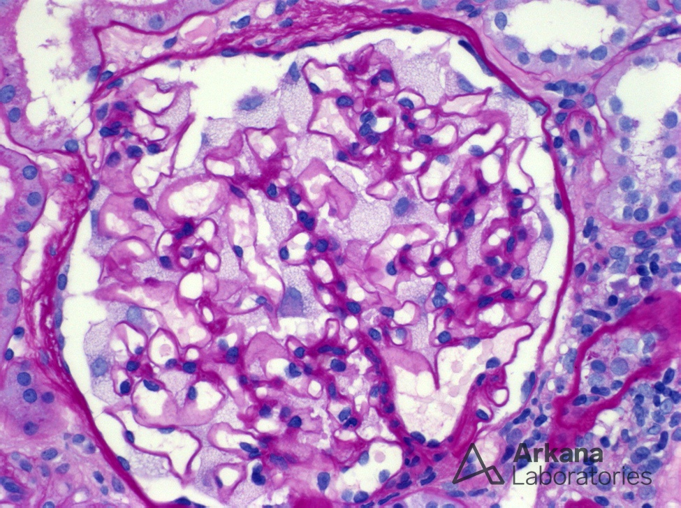 Fabry Disease