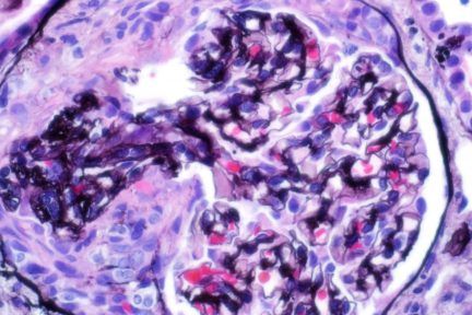 Anti-Glomerular Basement Membrane Disease