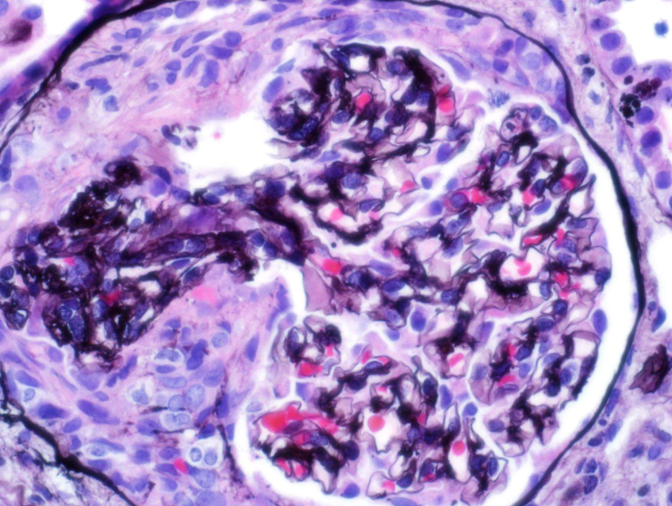 Anti-Glomerular Basement Membrane Disease