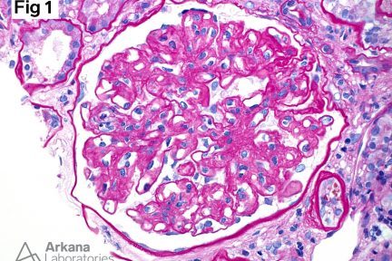 Fibrillary Glomerulopathy