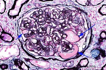 Diabetic Nephropathy