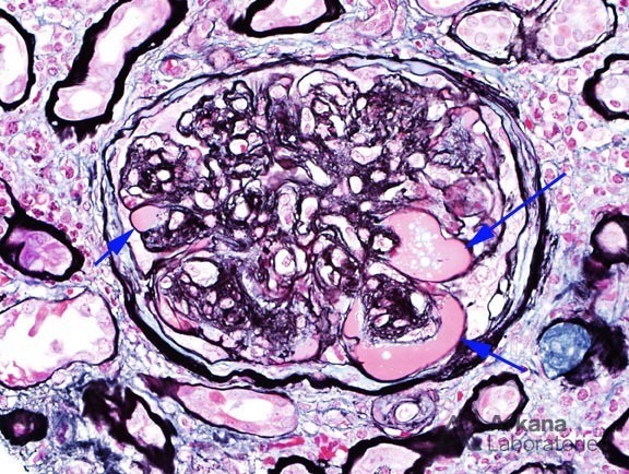 Diabetic Nephropathy