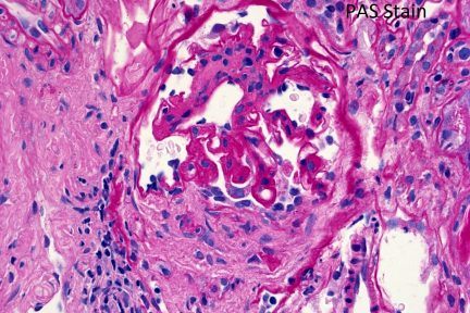 Membranous-like Glomerulopathy with Masked IgG Kappa Deposits