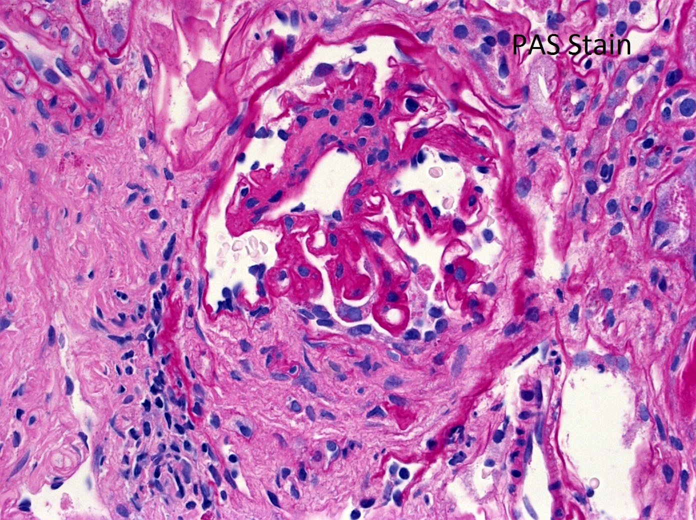 Membranous-like Glomerulopathy with Masked IgG Kappa Deposits