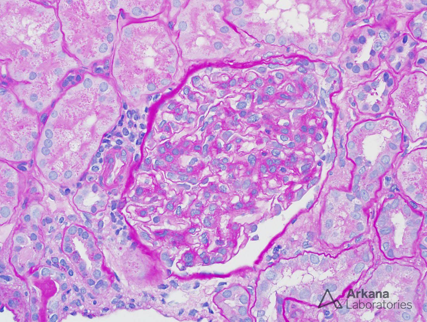 Minimal Change Disease and New Onset DM Type I