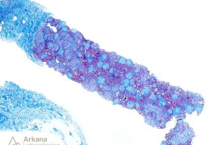 Amyloidosis