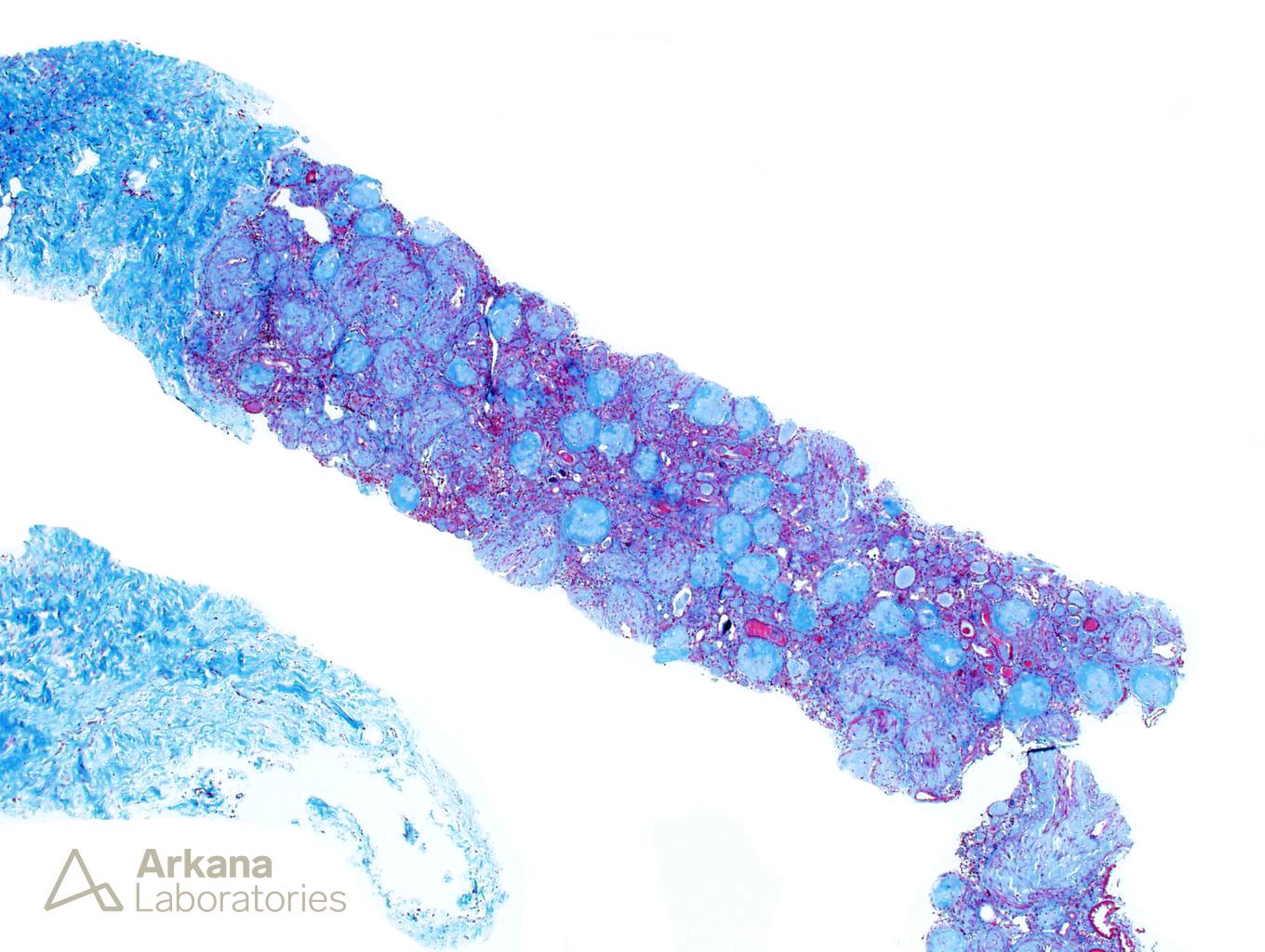 Amyloidosis