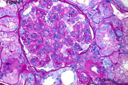 Proliferative Glomerulonephritis with Monoclonal IgG Deposits (PGMID)