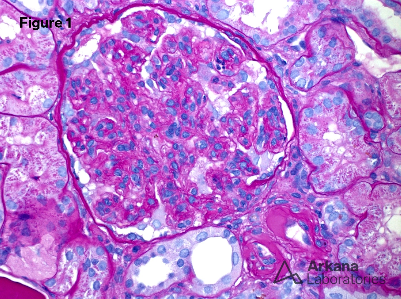 Proliferative Glomerulonephritis with Monoclonal IgG Deposits (PGMID)