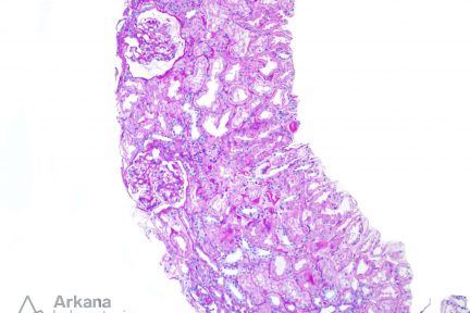 renal cortex from renal biopsy showing Light Chain Deposition Disease