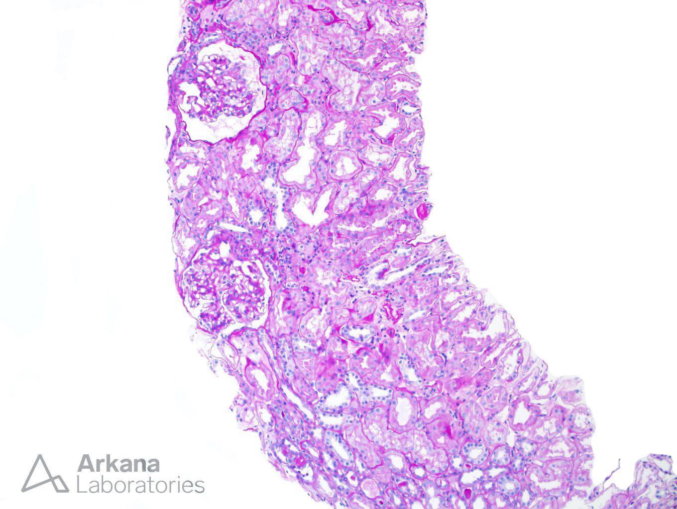 renal cortex from renal biopsy showing Light Chain Deposition Disease