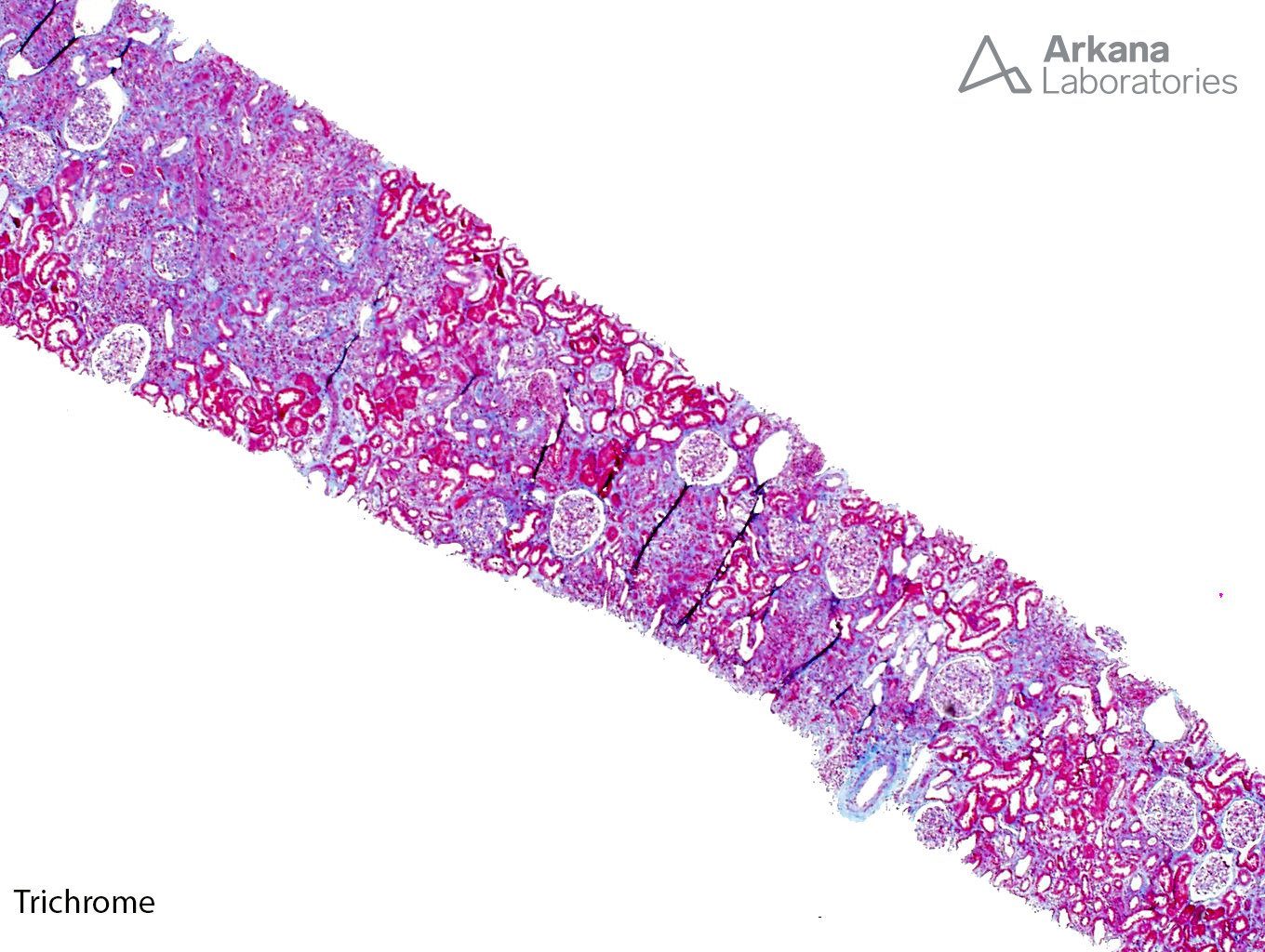 BK nephritis