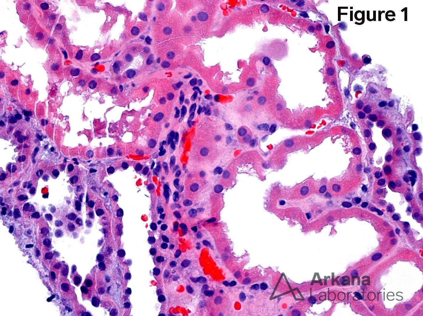 Acute Tubular Injury with Legionella