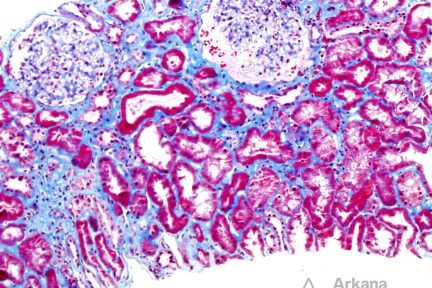 Light Chain Deposition Disease