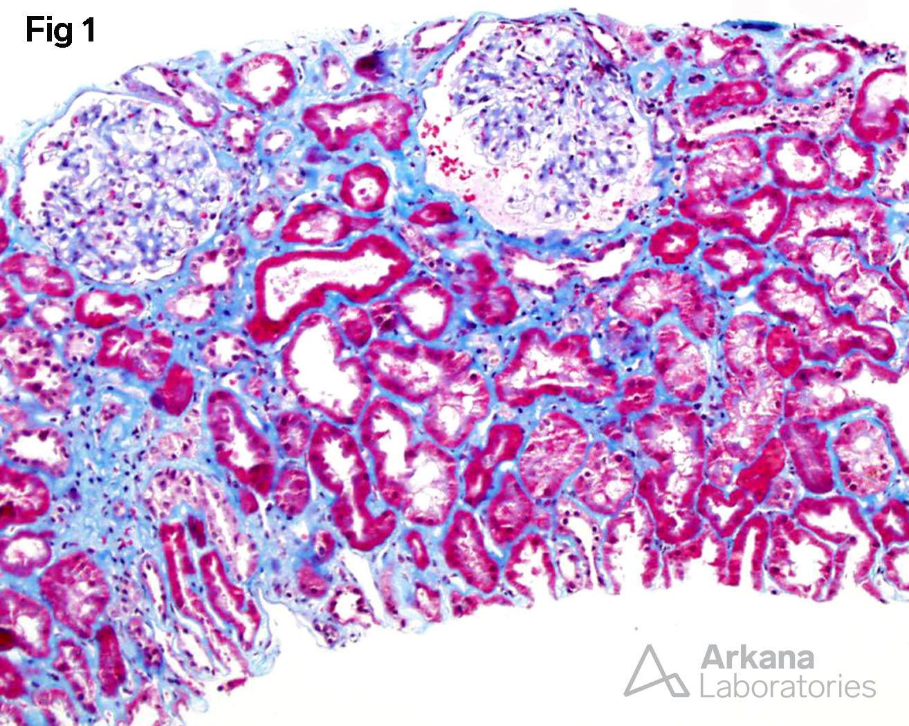 Light Chain Deposition Disease