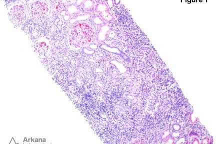 Chronic Active Tubulointerstitial Nephritis