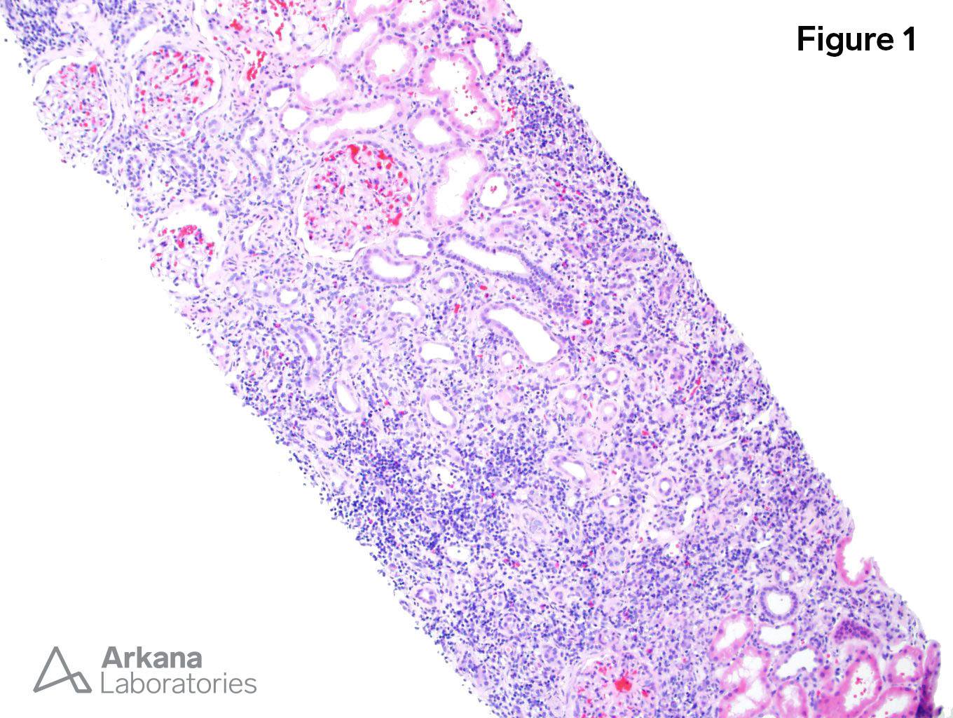 Chronic Active Tubulointerstitial Nephritis