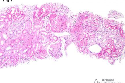 Focal Lupus Nephritis, mesangial hypercellularity