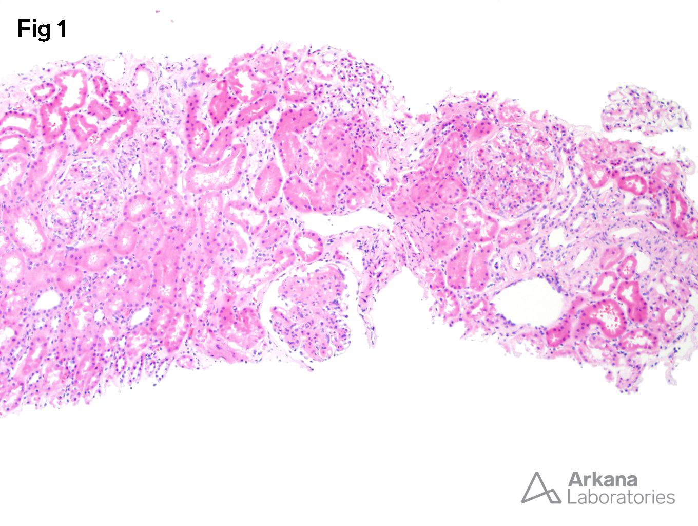 Focal Lupus Nephritis, mesangial hypercellularity