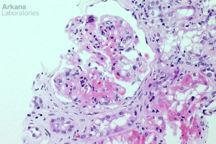 Fibrillary Glomerulopathy