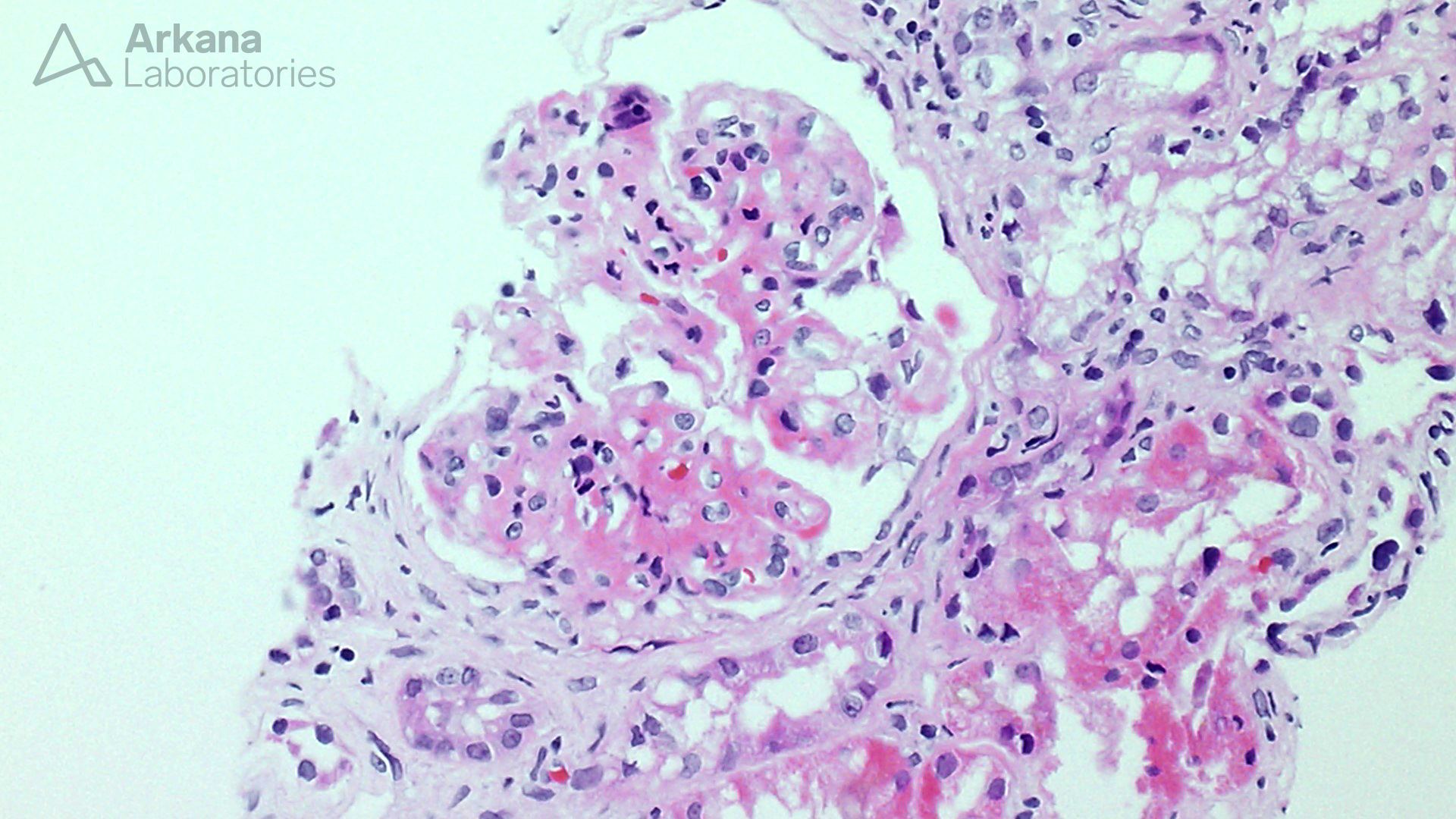 Fibrillary Glomerulopathy