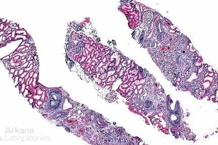 Lithium-Induced Nephropathy, kidney disease, arkana laboratories, acute renal disease