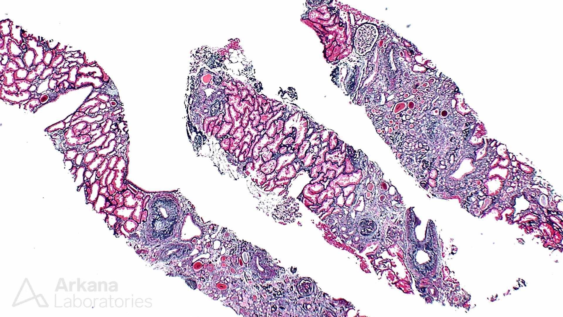 Lithium-Induced Nephropathy, kidney disease, arkana laboratories, acute renal disease