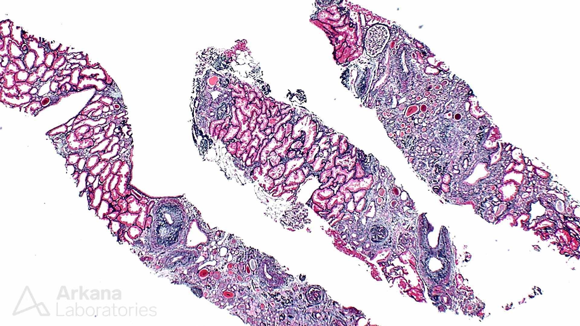 Lithium-Induced Nephropathy, kidney disease, arkana laboratories, acute renal disease