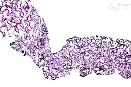 A-galactosidase A , pushing glass, arkana laboratories, kidney disease