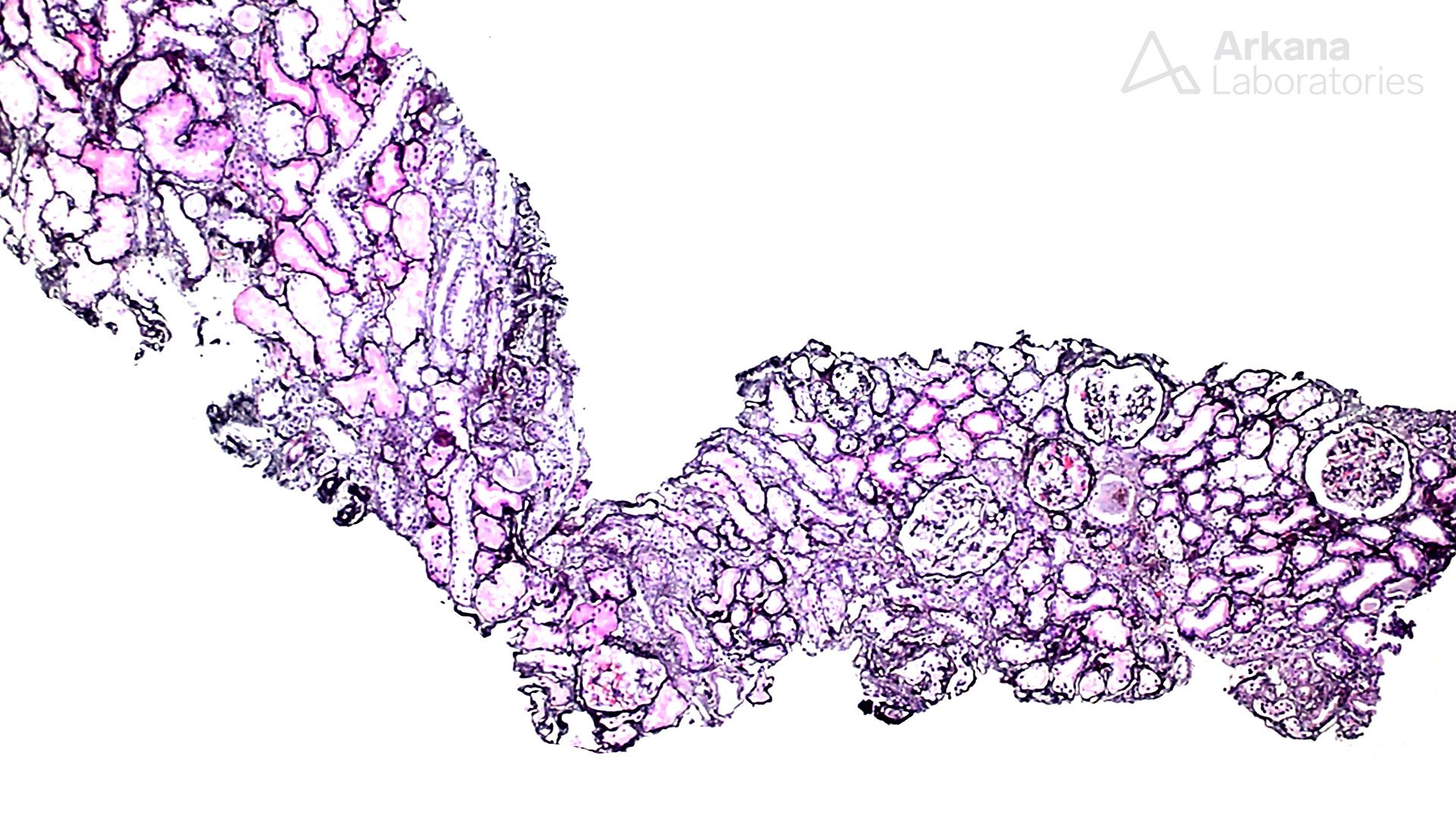 A-galactosidase A , pushing glass, arkana laboratories, kidney disease