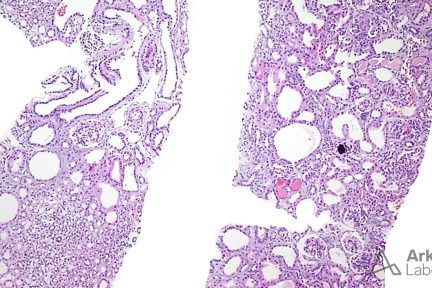 Congenital Nephrotic Syndrome of the Finnish type (CNSF)