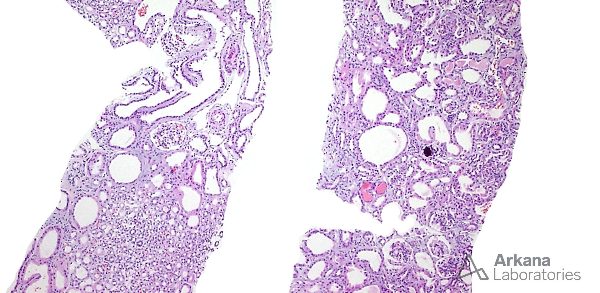 Congenital Nephrotic Syndrome of the Finnish type (CNSF)