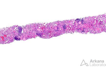 renal cortex from renal biopsy showing Atheroembolism