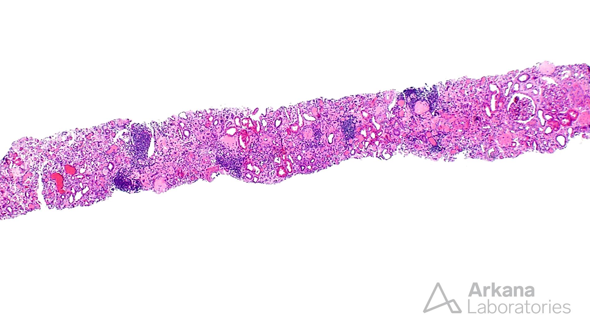 renal cortex from renal biopsy showing Atheroembolism