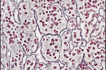 pituitary adenoma, pituitary gland tumor, arkana laboratories, neuro notes, neuropathology