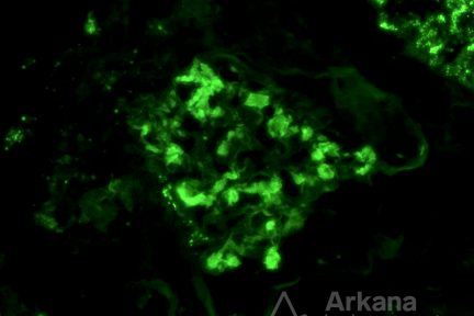 amyloidosis, AL-type, immunofluorescence in renal pathology, kidney biopsy, congo red stain, Arkana Laboratories