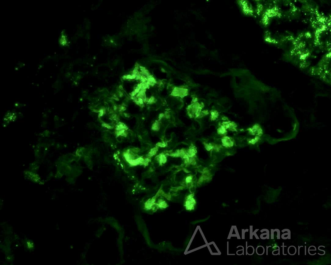 amyloidosis, AL-type, immunofluorescence in renal pathology, kidney biopsy, congo red stain, Arkana Laboratories