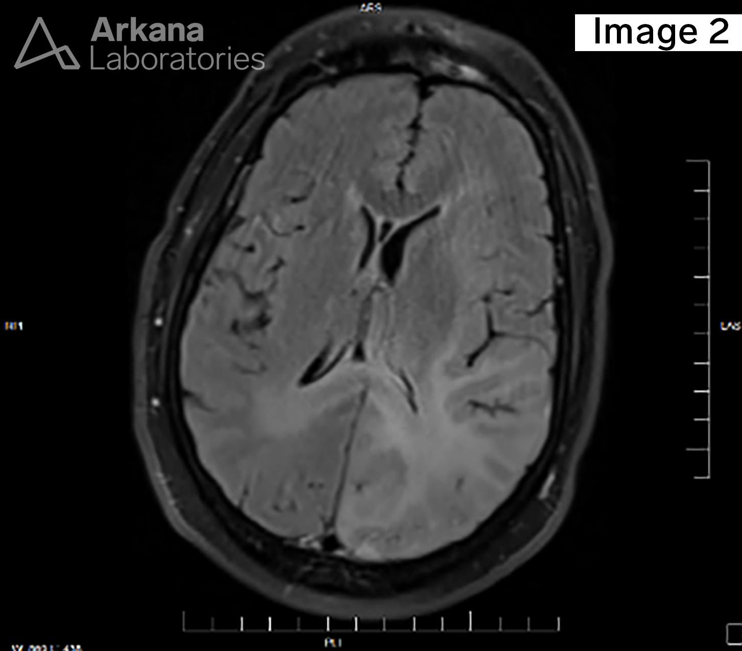 Diffuse Astrocytoma IDH-Mutant