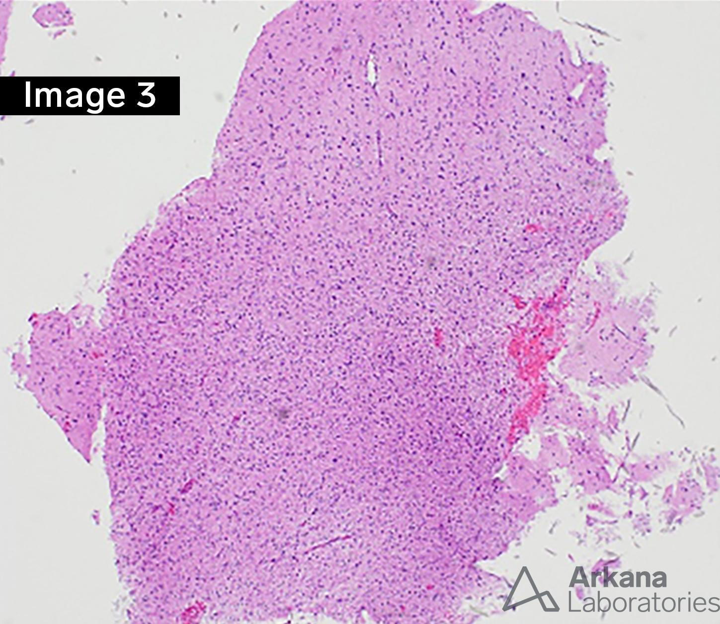 Diffuse Astrocytoma IDH-Mutant