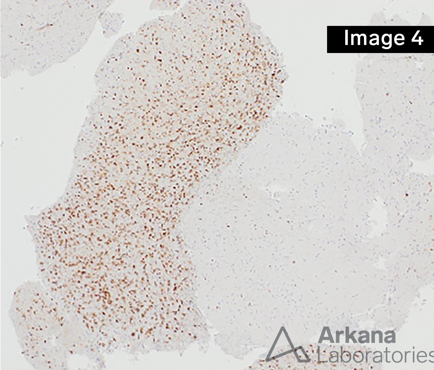 Diffuse Astrocytoma IDH-Mutant
