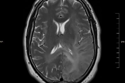 brain biopsy, Diffuse Astrocytoma IDH-Mutant, neuro notes, neuropathology